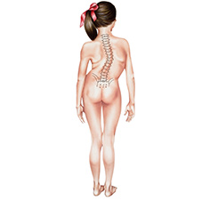 Adolescent Idiopathic Scoliosis