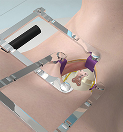 Anterior Cervical Decompression and Fusion