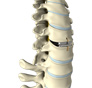 Artifical Cervical Disk Replacement