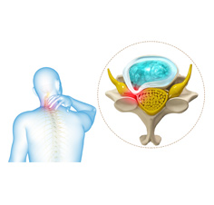 Cervical Radiculopathy-Myelopathy