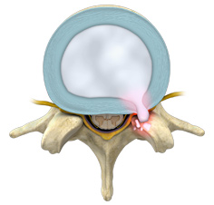 Disc Herniation