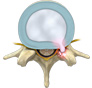 Disc Herniation