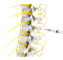 Epidural Injection Surgery