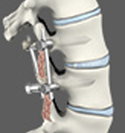 Lumbar Fusion