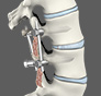 Lumbar fusion