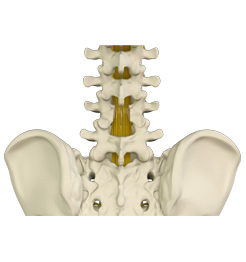 Lumbar Laminectomy