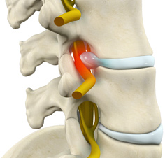 Lumbar Radiculopathy