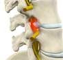 Lumbar Radiculopathy