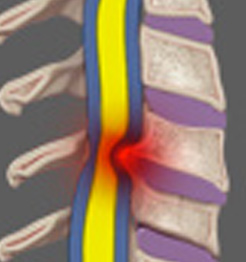 Minimally Invasive Cervical Decompression