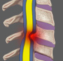 Minimally invasive cervical Decompression