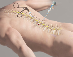 Minimally Invasive Spine Surgery