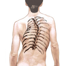 Scoliosis