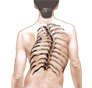 Scoliosis