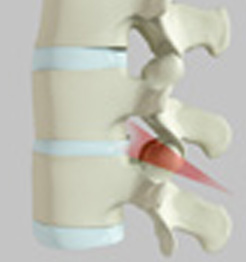 Spinal Osteotomy