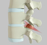 Spinal Osteotomy