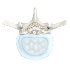 Spinal Stenosis