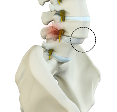 Spondylolisthesis