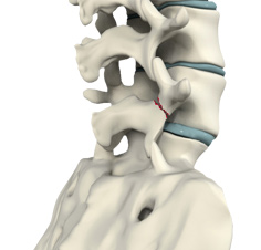 Spondylolysis