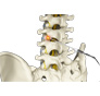 Spondylolysis