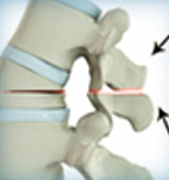 Vertebral Column Resection